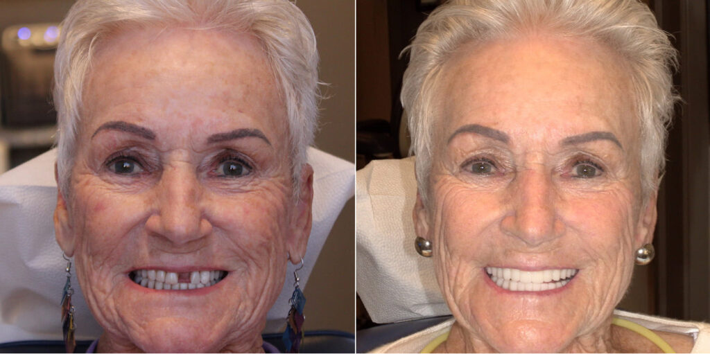 Overcoming Fractured_Worn Full-Arch Implant Prosthesis - before - after preview