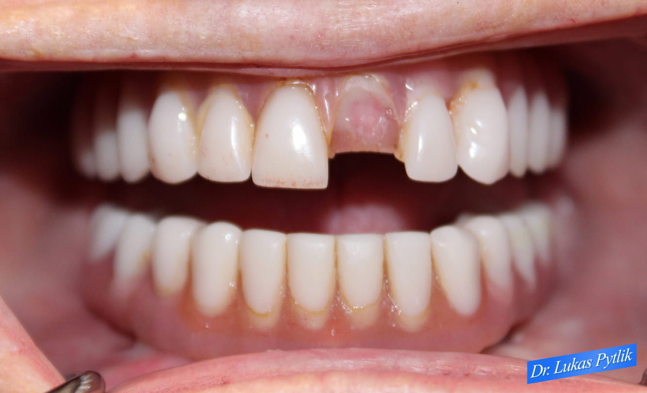 Retracted #9 fracture before - Patient - Janette