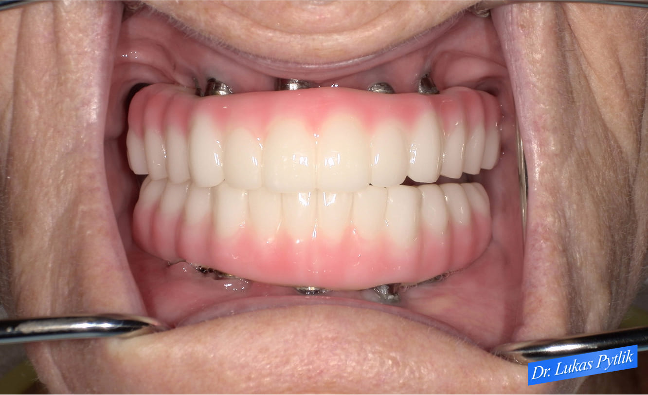 Retracted after - Patient - Janette