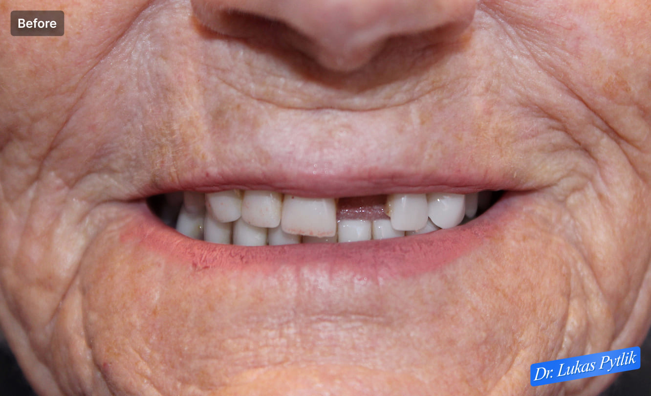 Up-close #9 fracture before - Patient - Janette