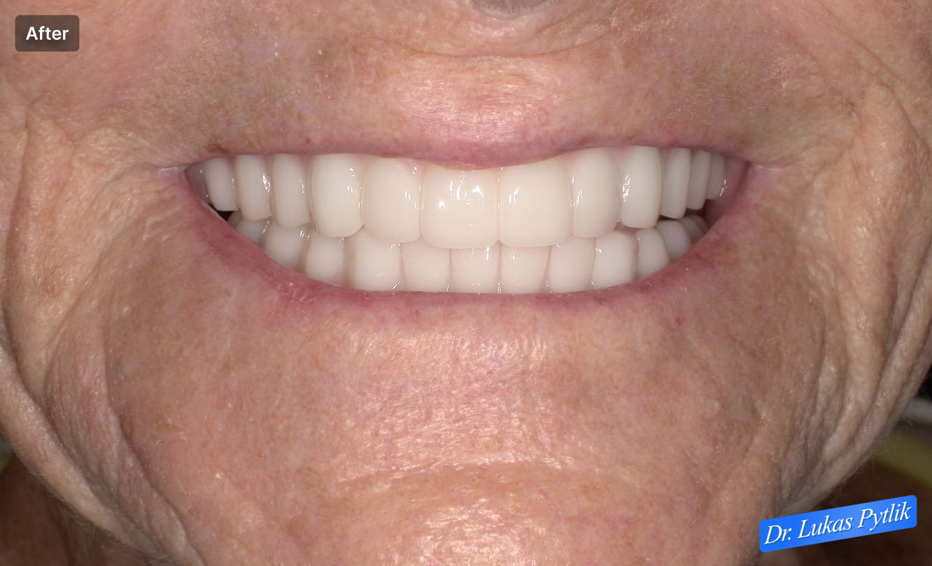 Up-close smile after - Patient - Janette