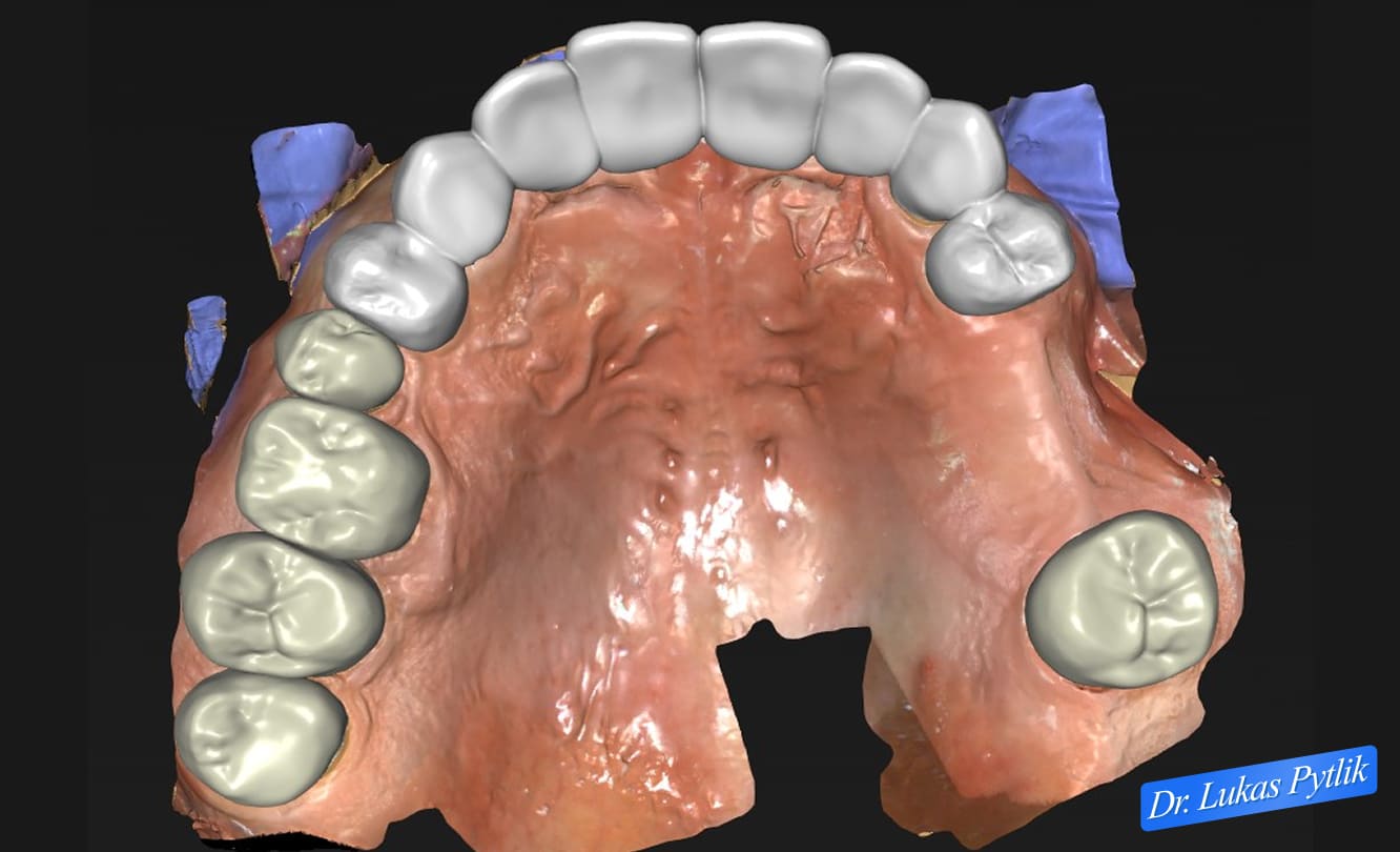 Maxillary Design, Occlusal View