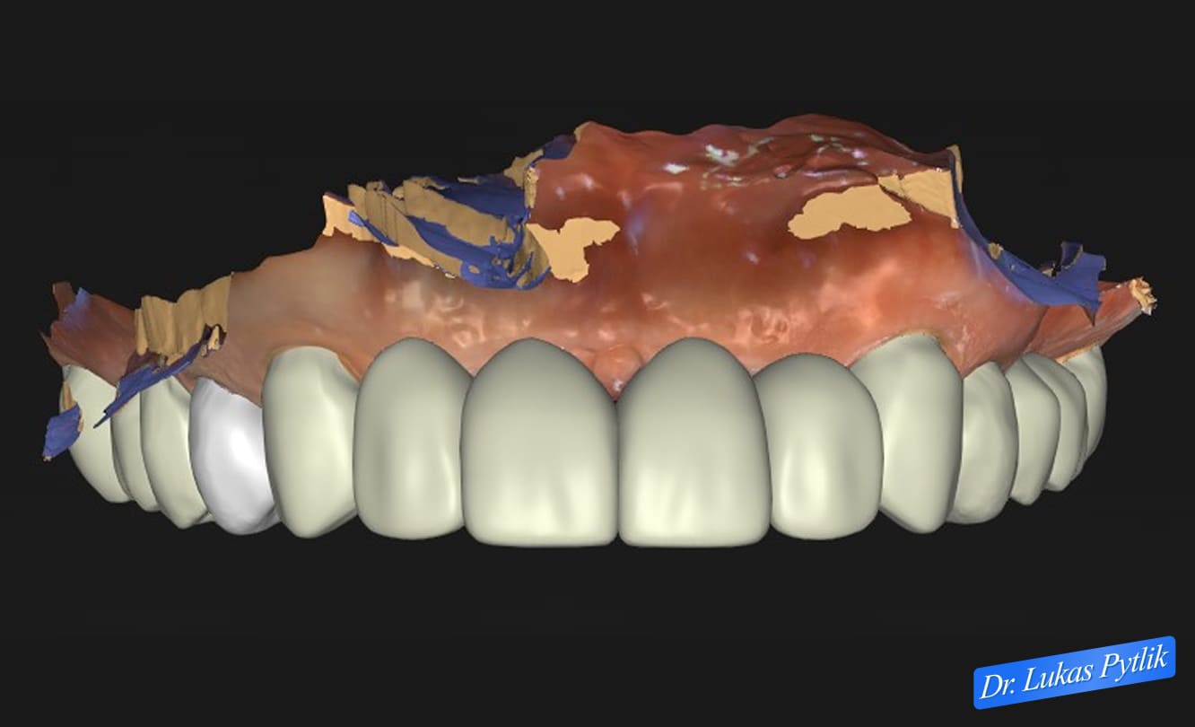 Maxillary Temporary Design, Front View