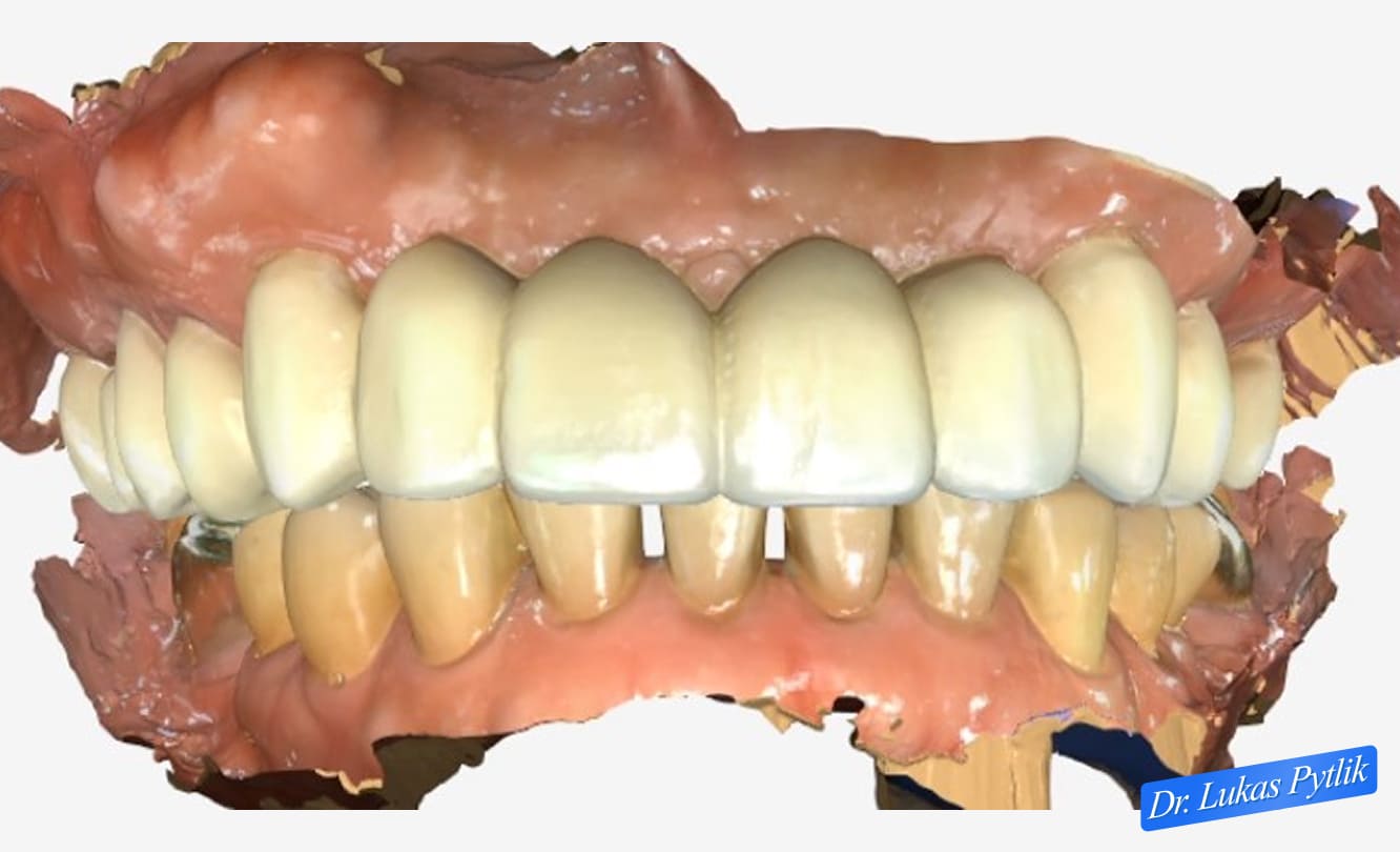 Final Bite and Restoration Scan