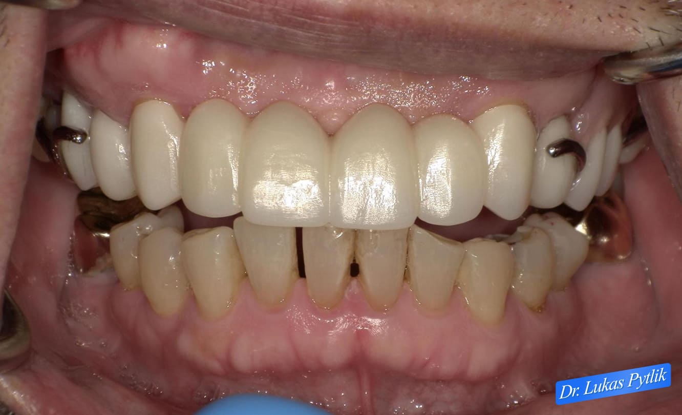 After, Retracted, Teeth Apart, with Partial