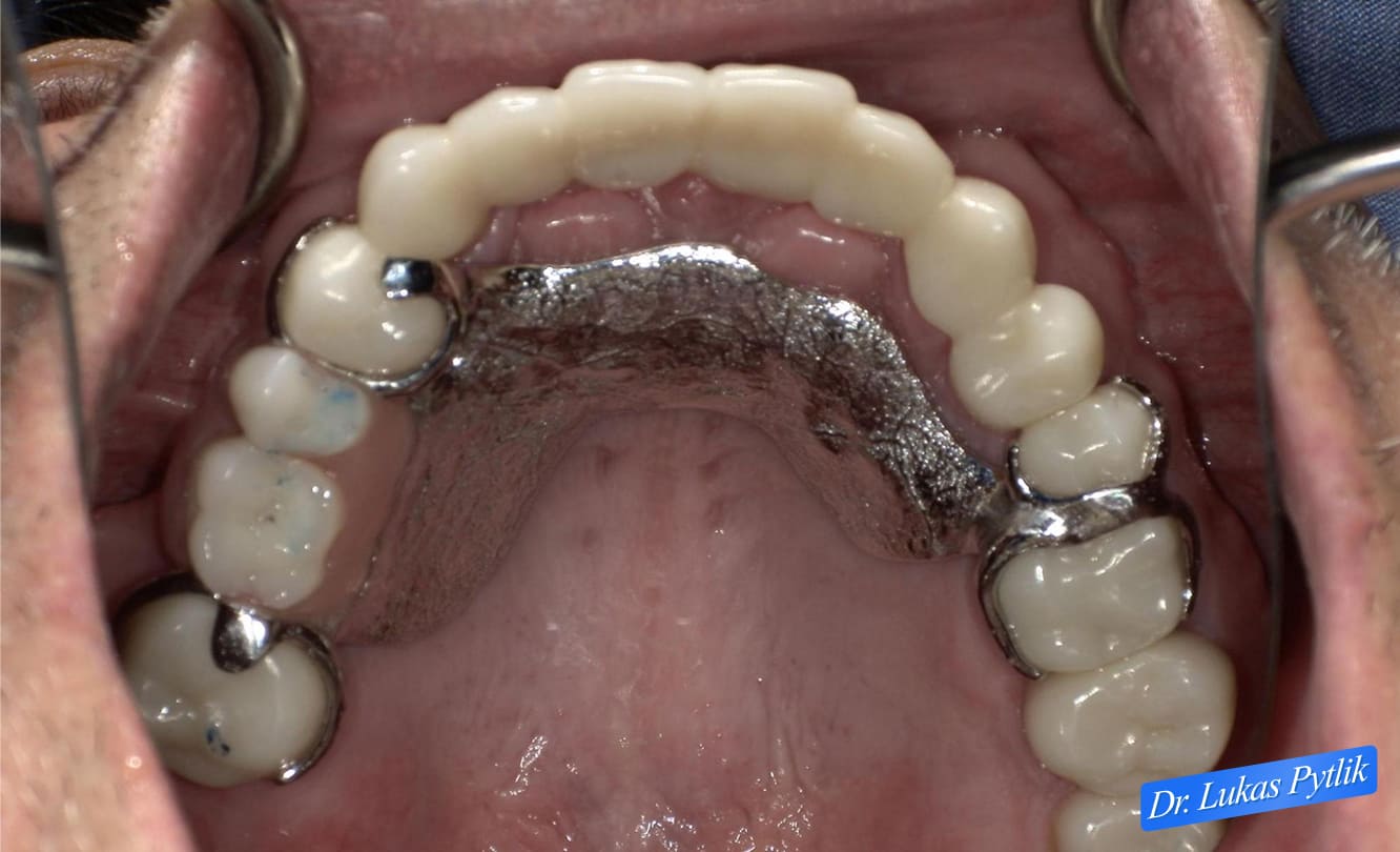 After, Retracted Maxillary View with Partial