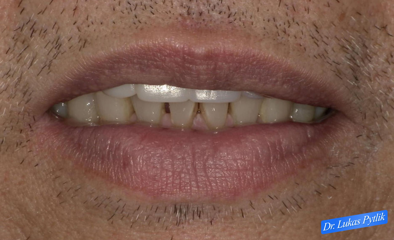 After, Repose Photo with Relaxed Lips