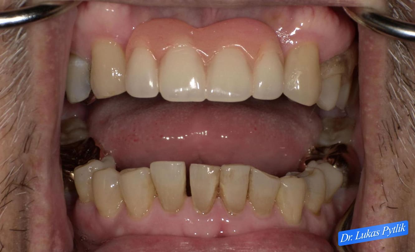 Before, Retracted Teeth Apart