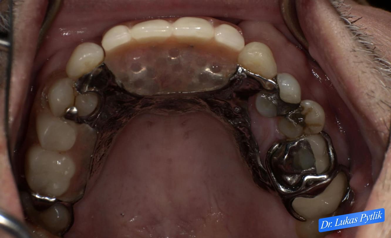 Before, Maxillary Arch Photo with Partial