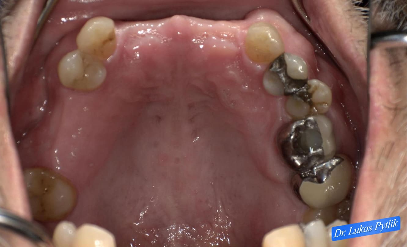 Before, Maxillary Arch Photo No Partial