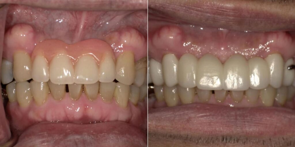 Before and after retracted view showing progression from removable partial denture with missing central incisor and visible gaps to completed fixed bridge restoration with natural aesthetics and comprehensive crown coverage in the maxillary arch.
