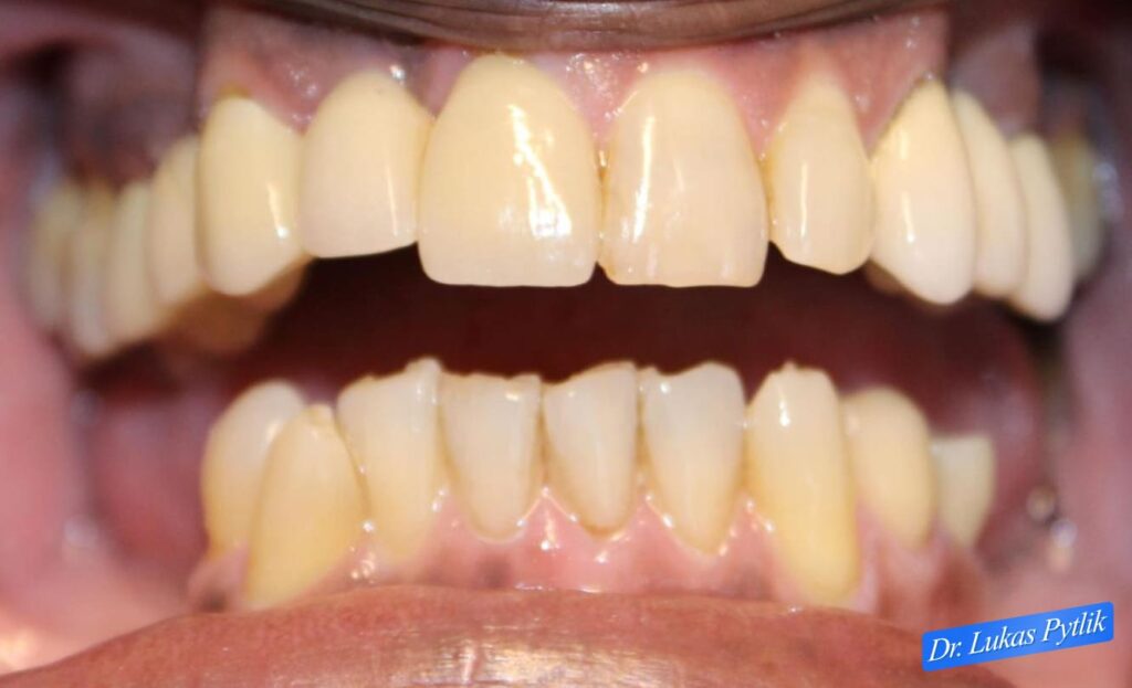 Before Retracted, Teeth Apart