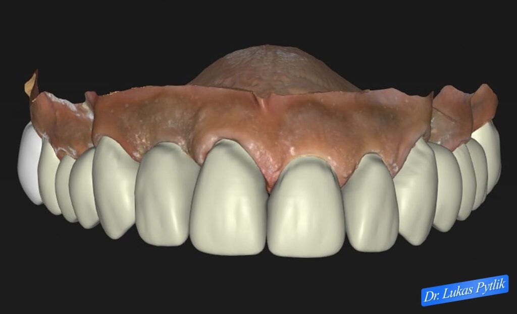 Maxillary Design, Front View