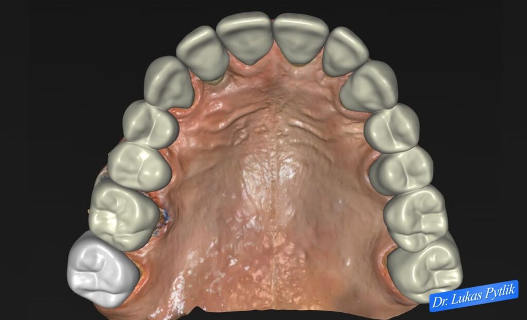 Maxillary Design, Occlusal View