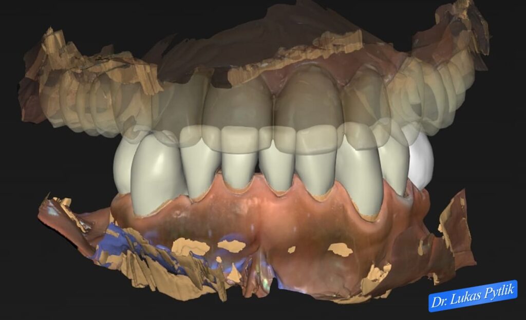 Mandibular Design, Front View