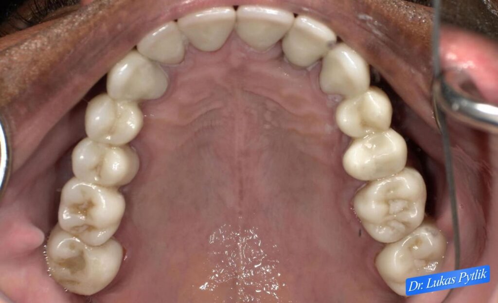After Occlusal View, Upper Arch