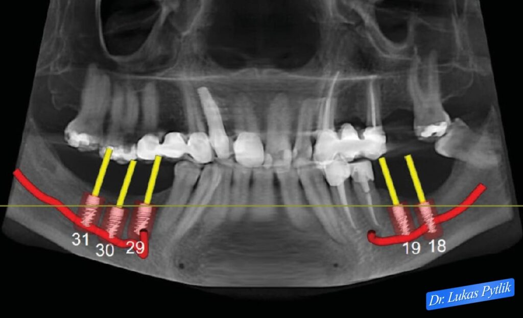 Before Implant Design for Lower Arch