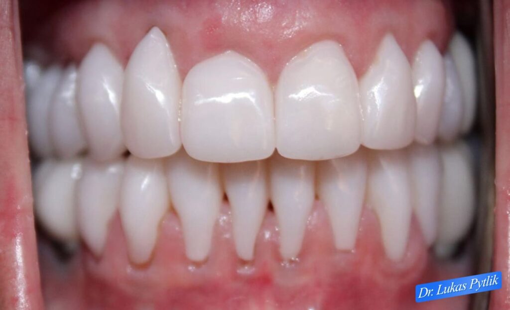 After, Retracted Teeth Together