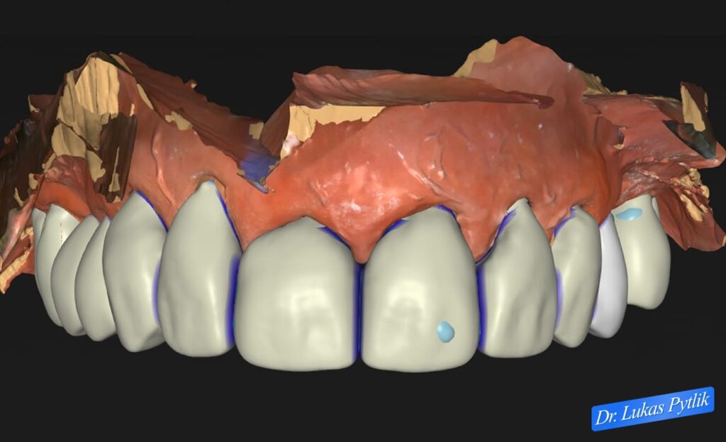 After, Maxilla Front View Design