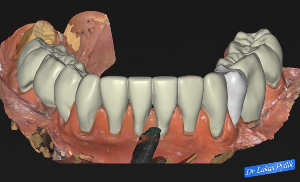 After, Mandible Front View Design