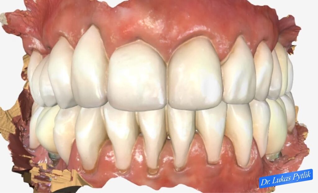 After, Maxilla and Mandible Finished Design, Case Scan