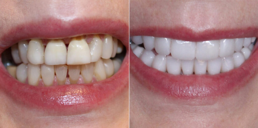 Before and after smile comparison showing progression from severe xerostomia with multiple cervical cavities, darkening, and decay at gum lines to comprehensive upper and lower arch restoration with full coverage crowns, achieving natural aesthetics with proper shade and contour.