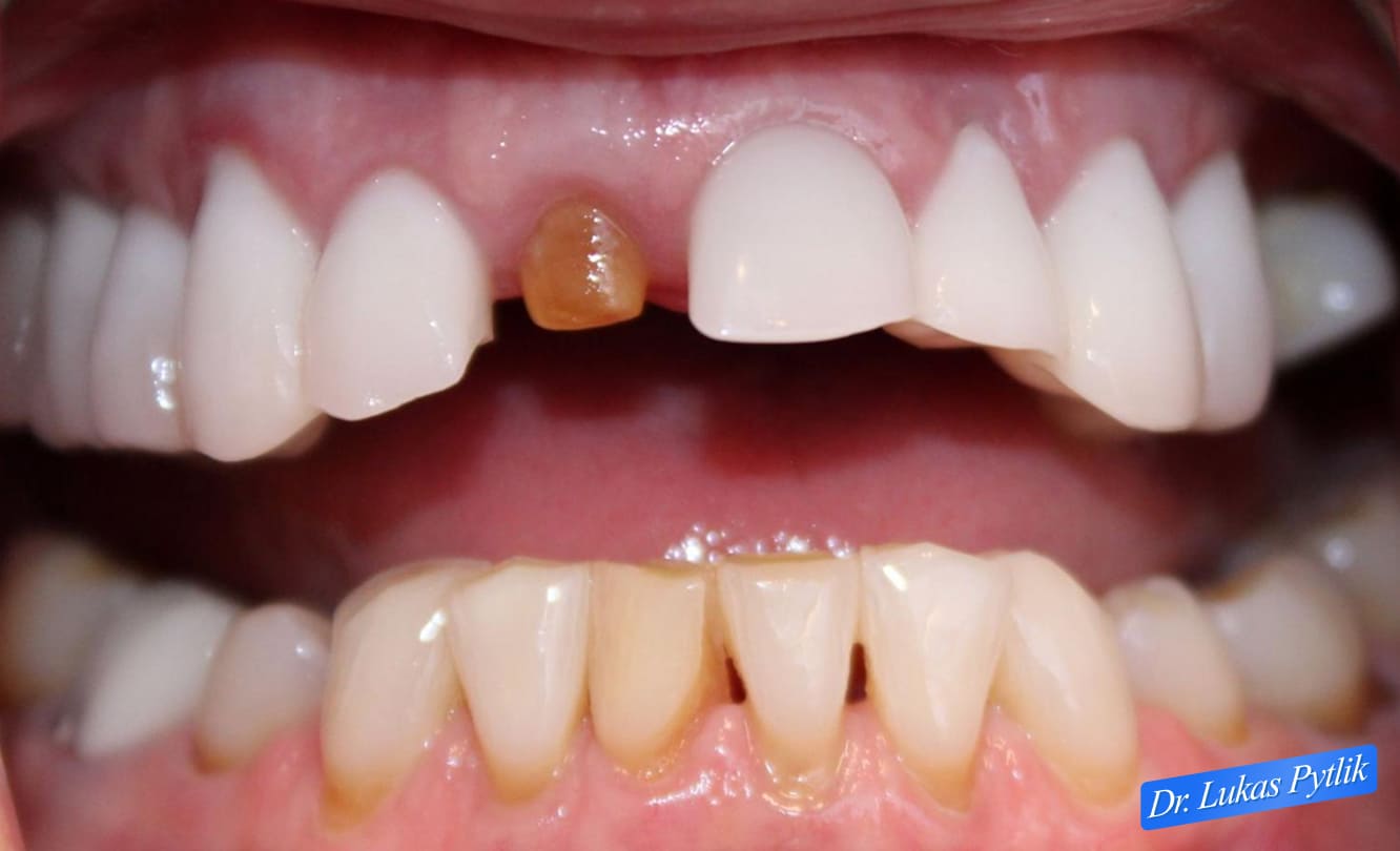 Lateral Smile View Before Treatment