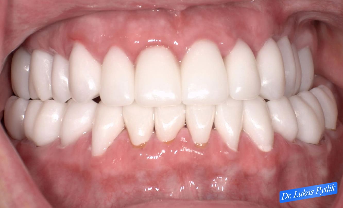 External Smile View After Full Mouth Rehabilitation