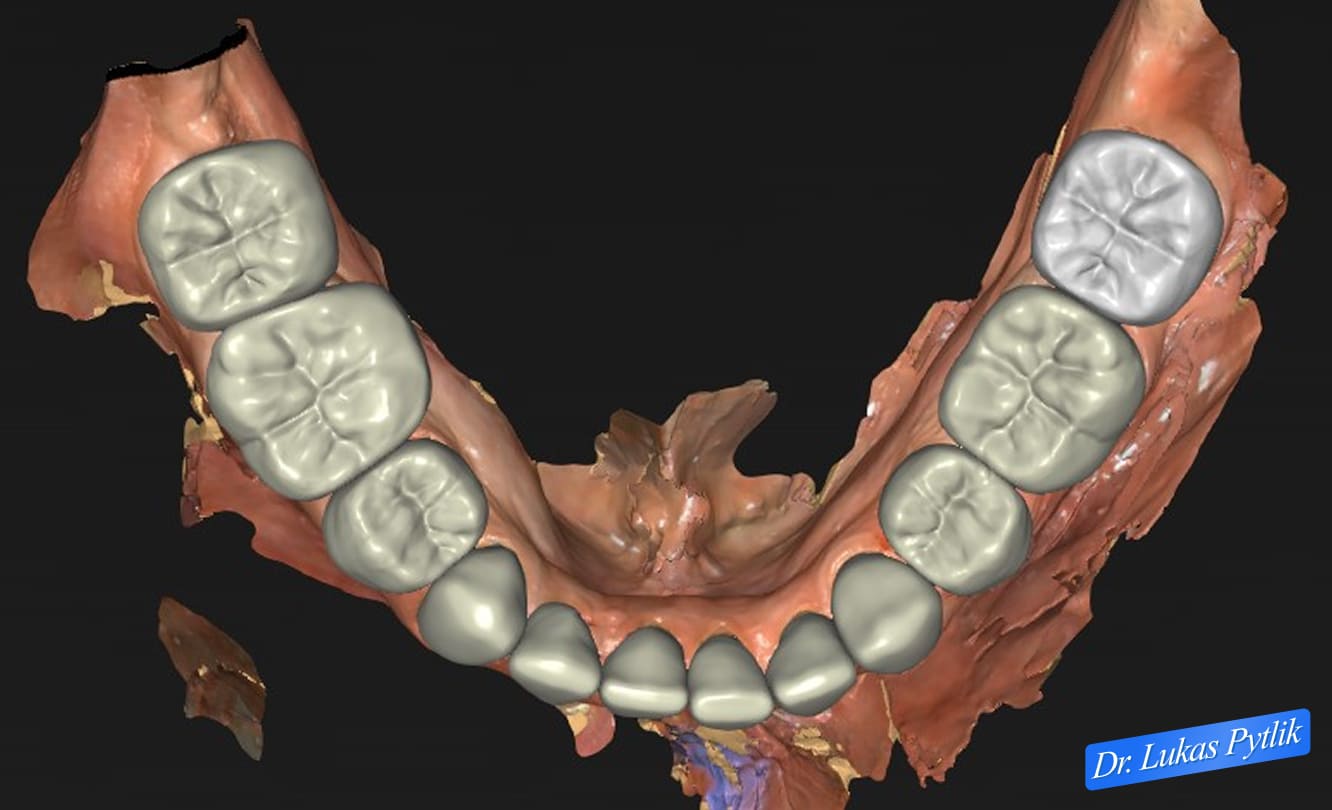 Digital Treatment Planning - Lateral View