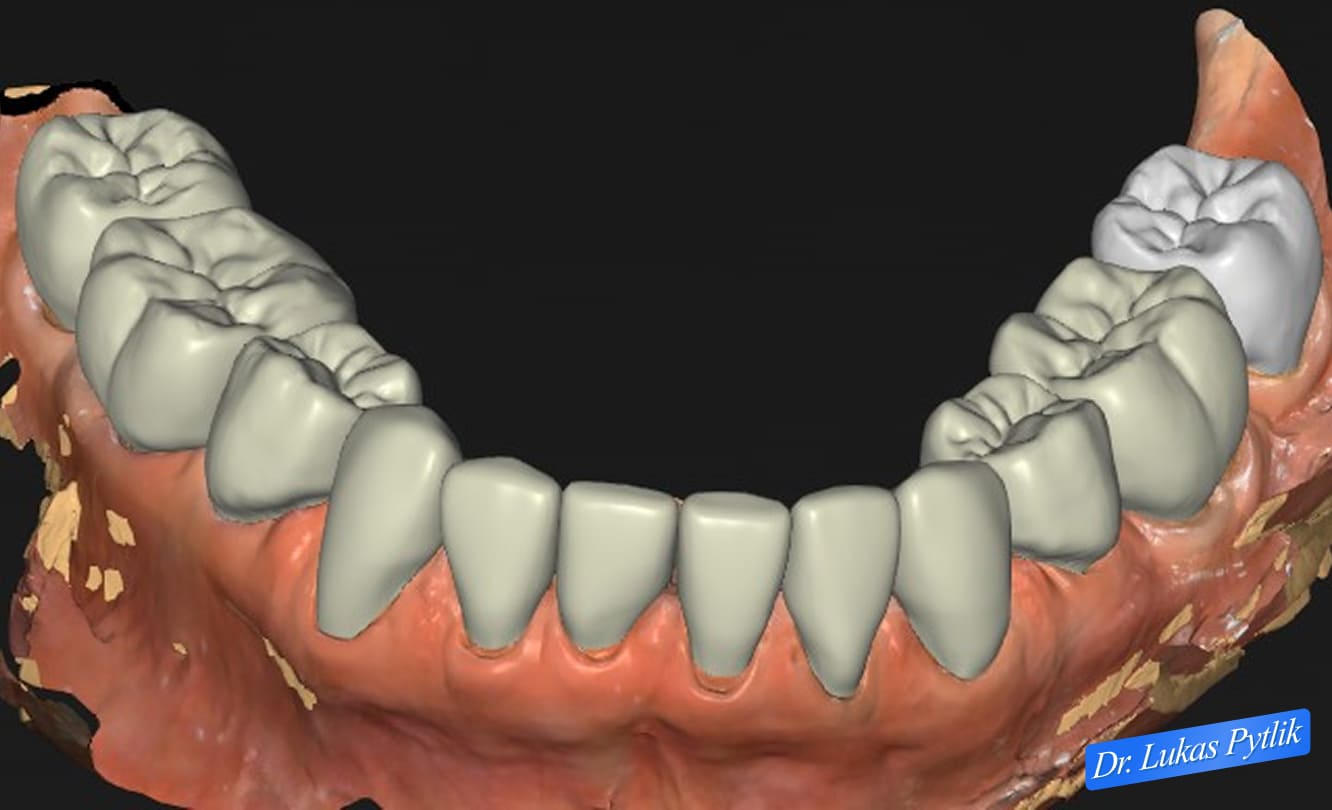 Digital Occlusal Analysis - Lower Arch
