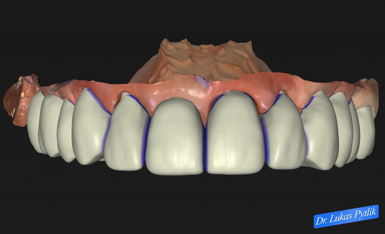 Digital Occlusal Analysis - Upper Arch