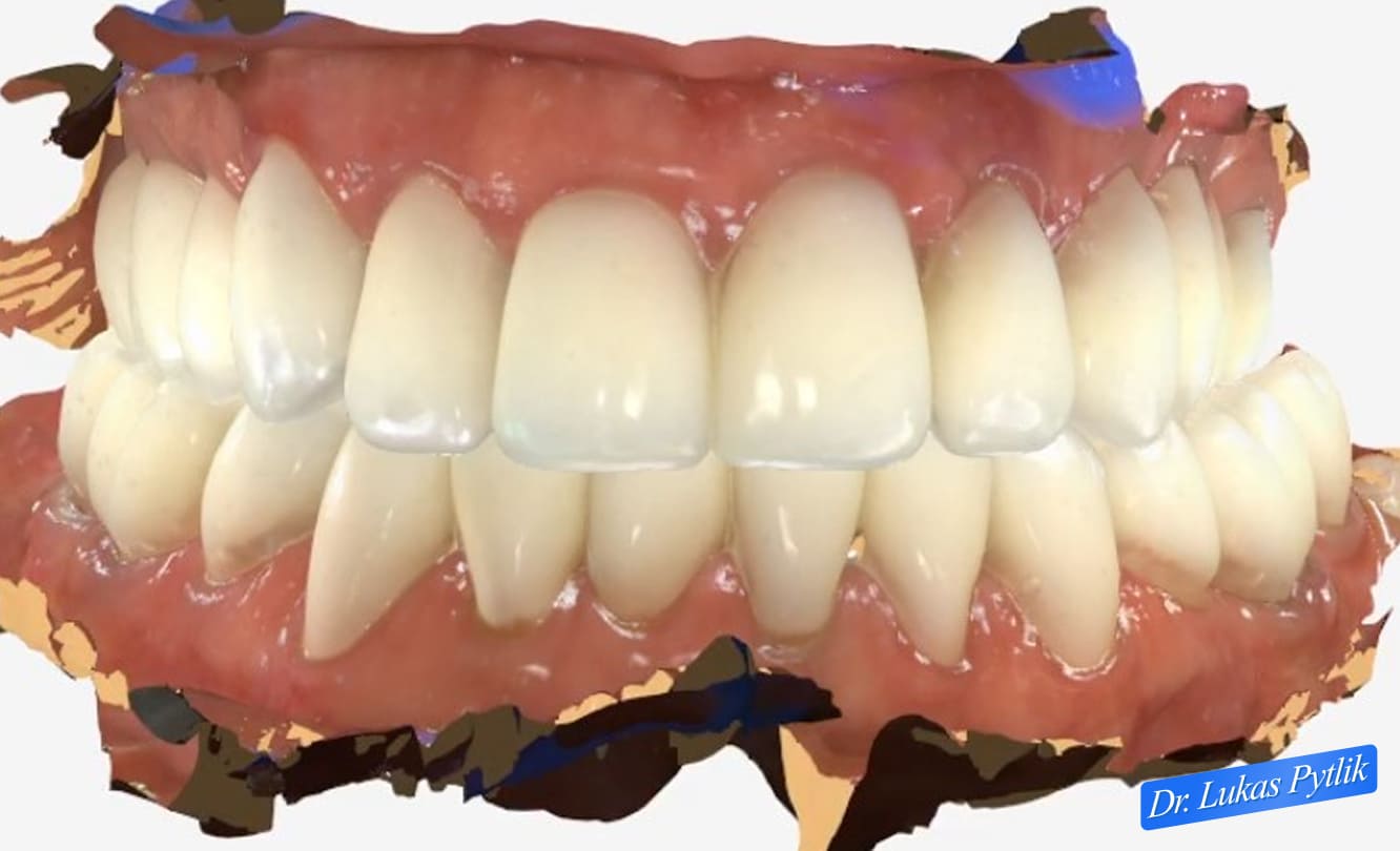 Digital Design - Proposed Upper Arch Restoration