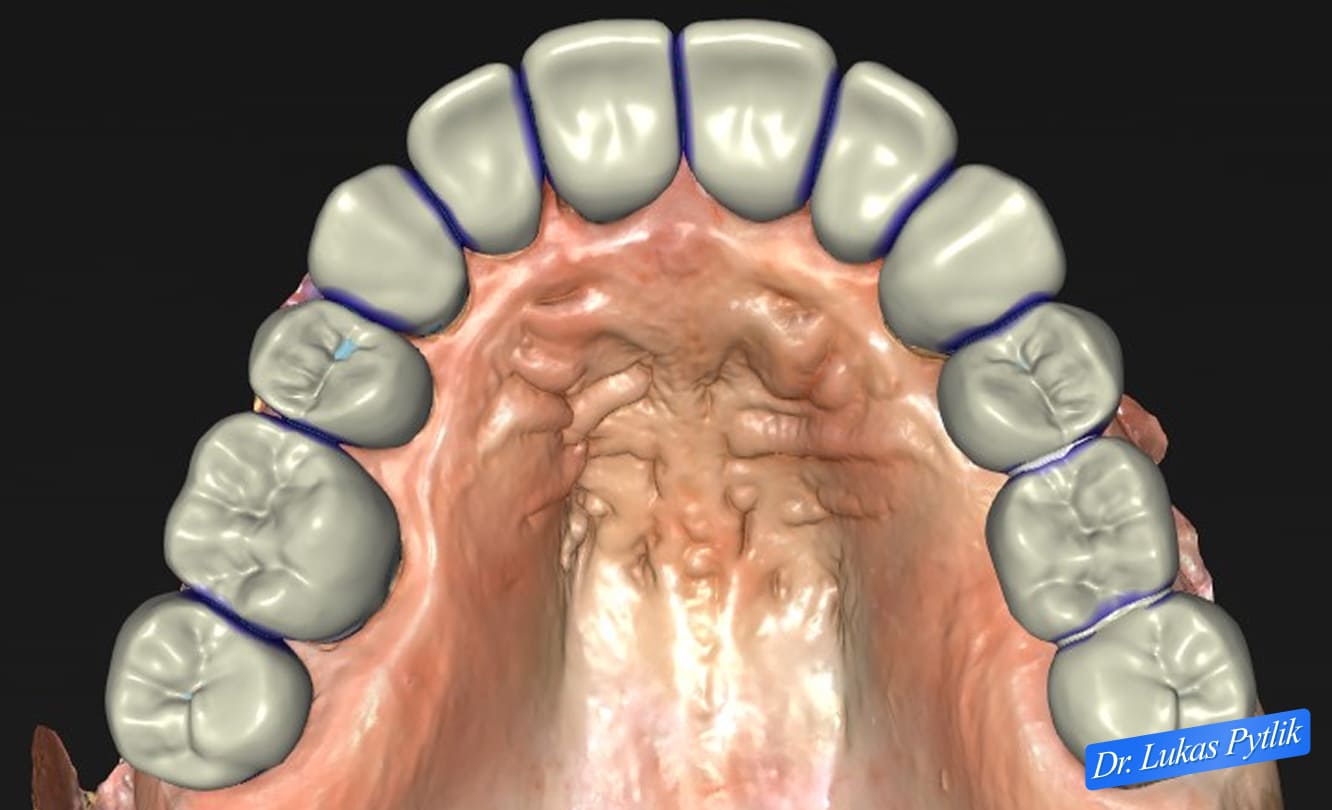 Digital Design - Occlusal View of Proposed Restorations