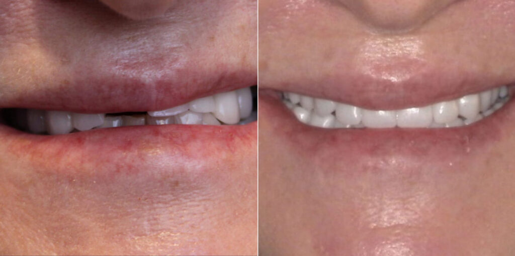 Before and after dental restoration showing progression from class III malocclusion with missing central incisor to comprehensive upper and lower arch restoration with corrected bite and improved aesthetics.